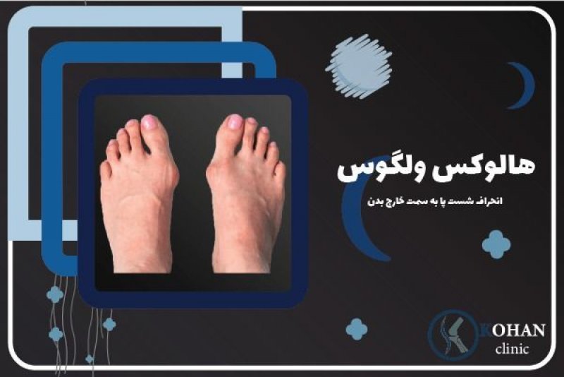 انحراف شست پا